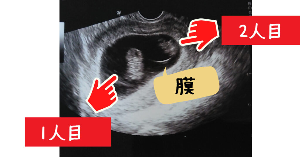 【妊娠8週目】総合病院で1絨毛膜2羊膜双胎と診断